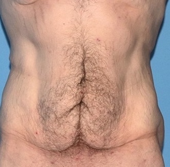 Antes da abdominoplastia masculina - caso 1