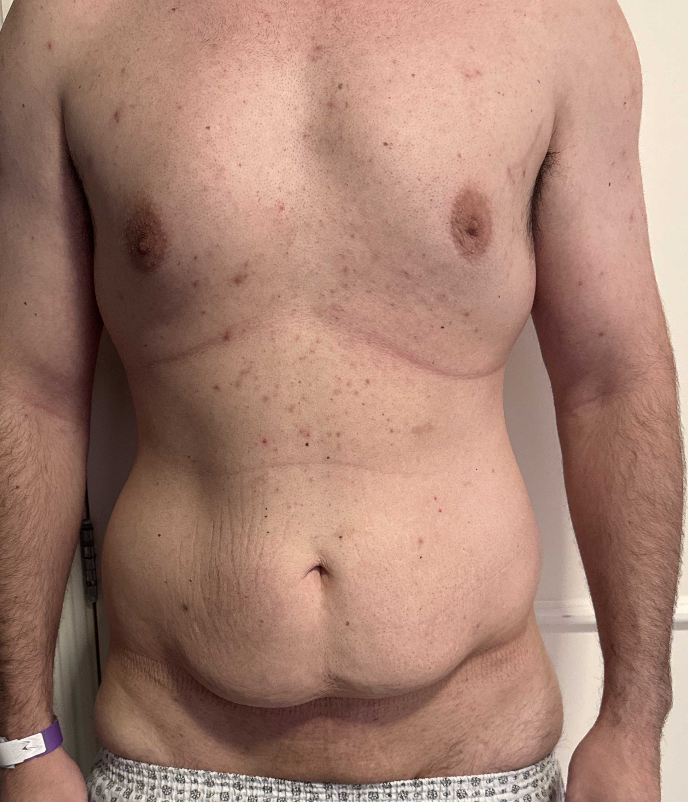 Antes da abdominoplastia masculina - caso 2