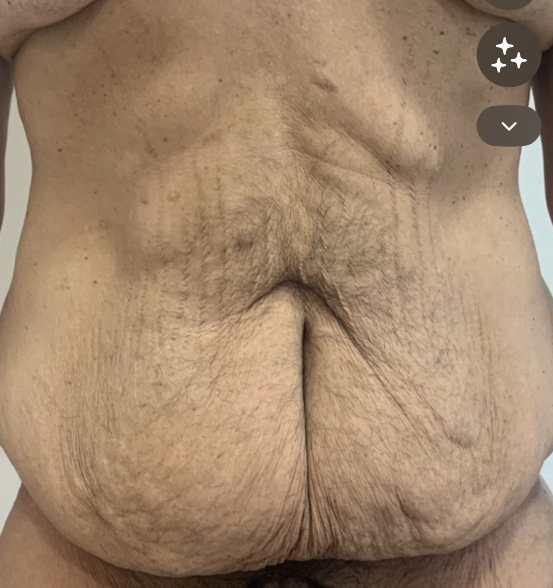 Antes da abdominoplastia masculina - caso 3