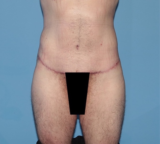 Depois da abdominoplastia masculina - caso 1