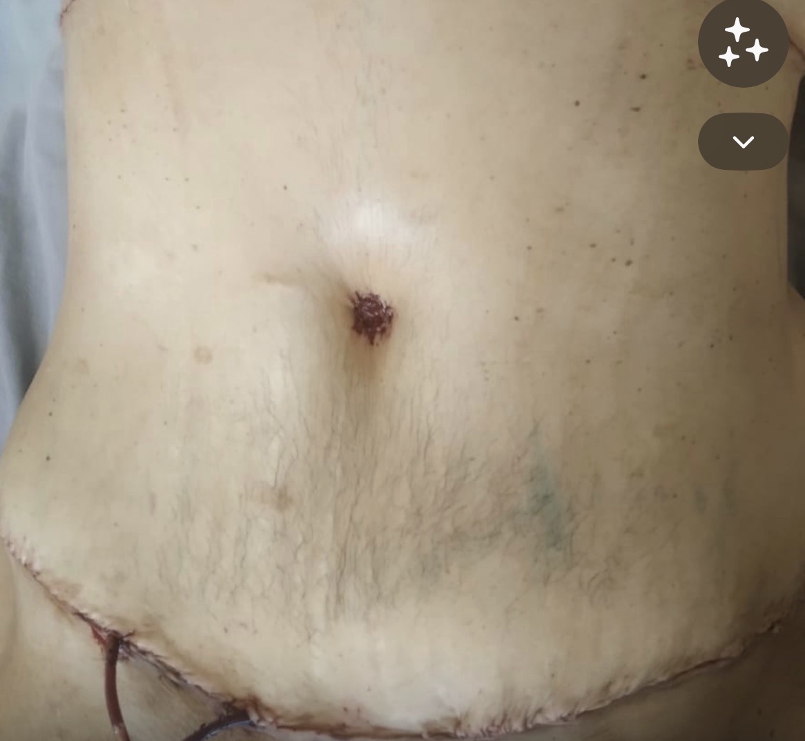 Depois da abdominoplastia masculina - caso 3