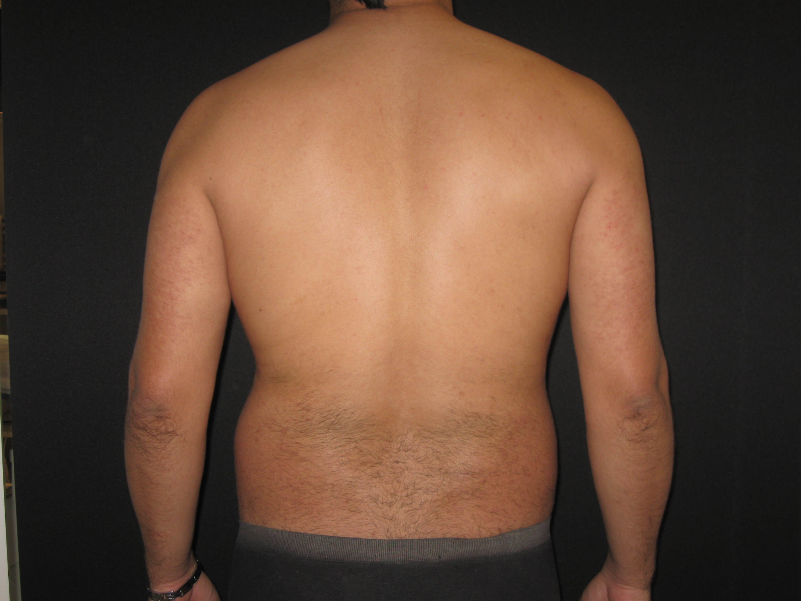 Antes da lipoaspiração masculina - caso 1