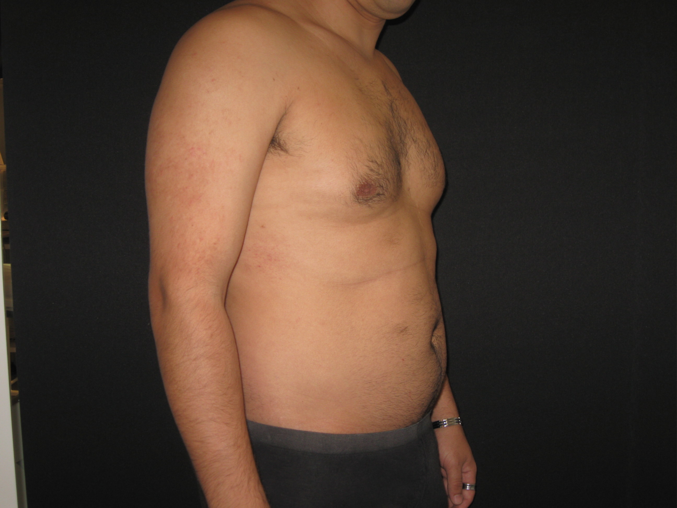 Antes da lipoaspiração masculina - caso 2