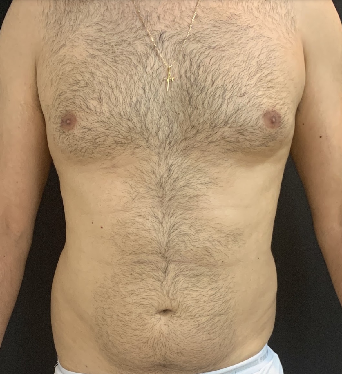 Antes da lipoaspiração masculina - caso 3