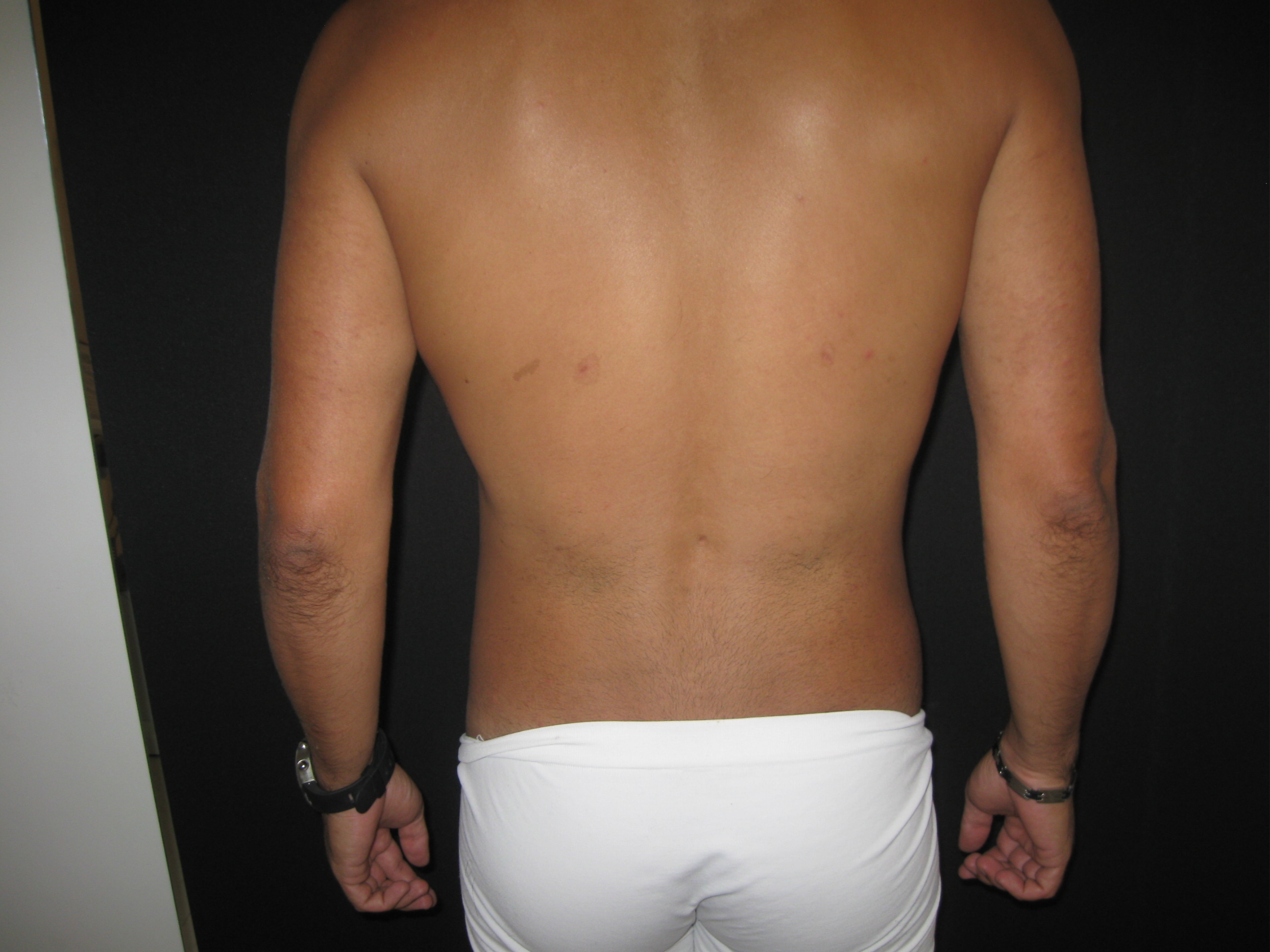 Depois da lipoaspiração masculina - caso 1
