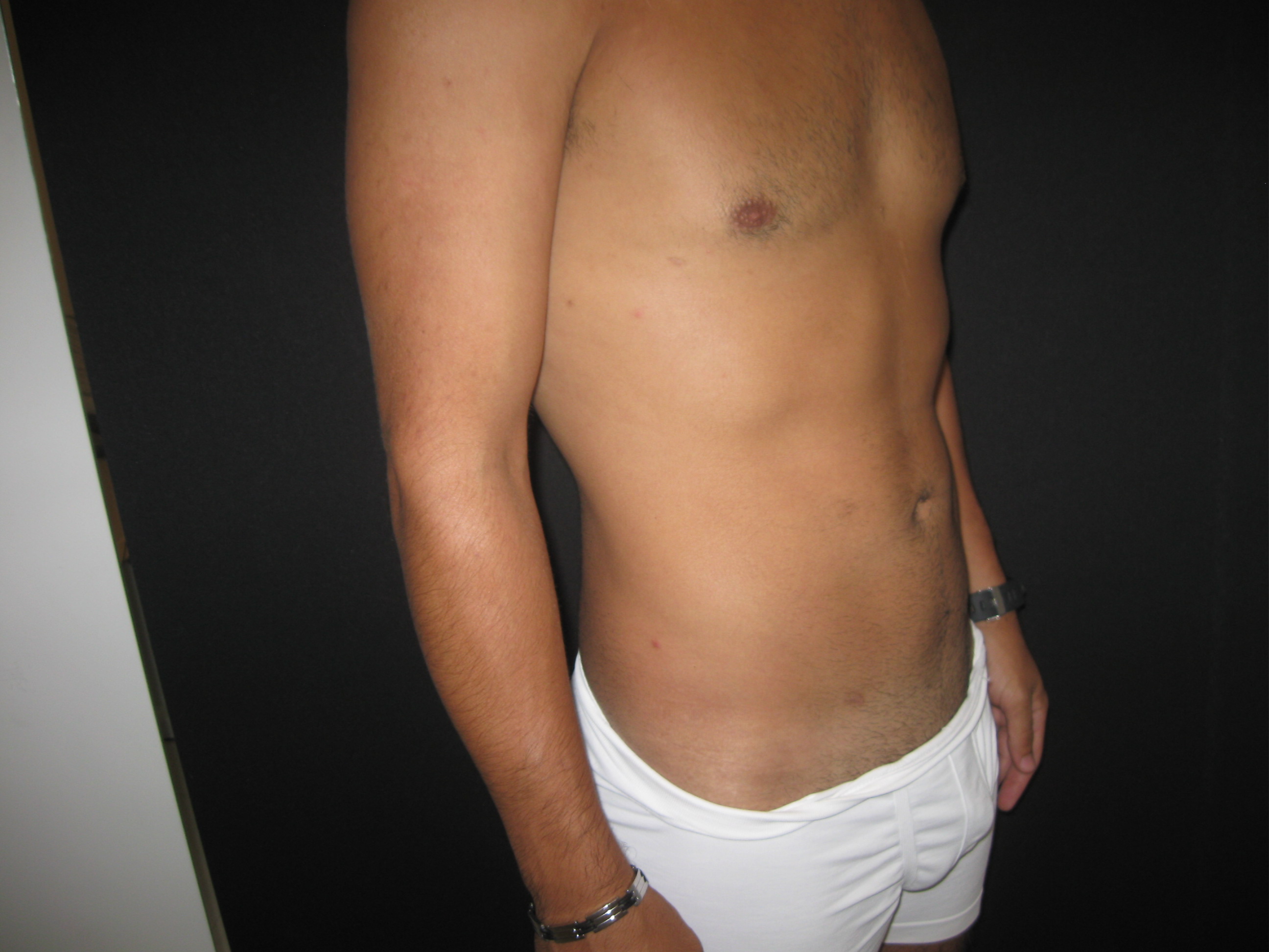 Depois da lipoaspiração masculina - caso 2