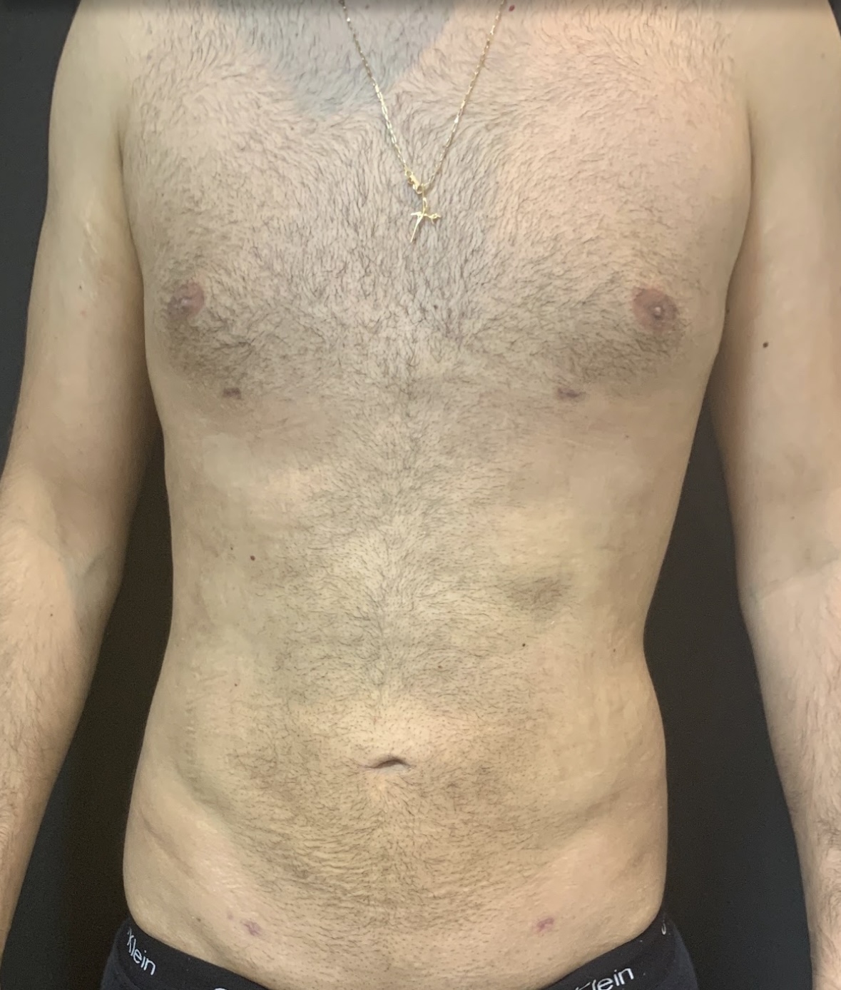 Depois da lipoaspiração masculina - caso 3